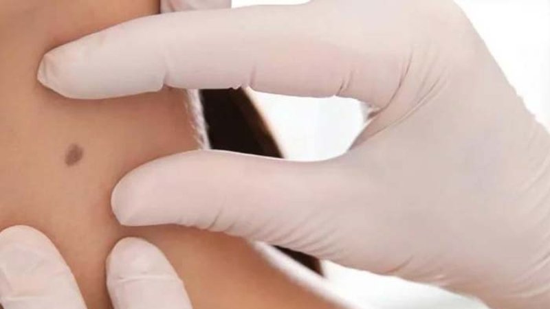 Skin check Morningside